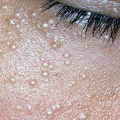 눈 주위 좁쌀, 비립종