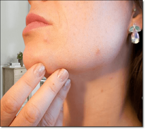 히알루론산 부작용 피부 발진