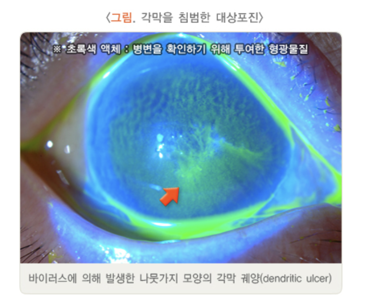 각막에 나타낸 대상포진