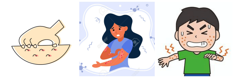 콜린성 두드러기 관련 사진 3개