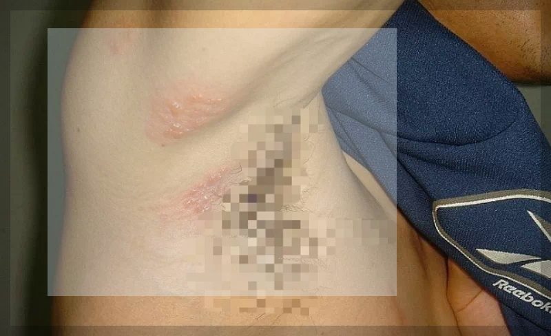 겨드랑이 대상포진