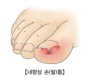 부산 내성발톱