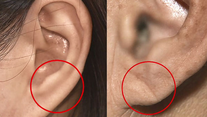 뇌졸중 전조증상 귀주름