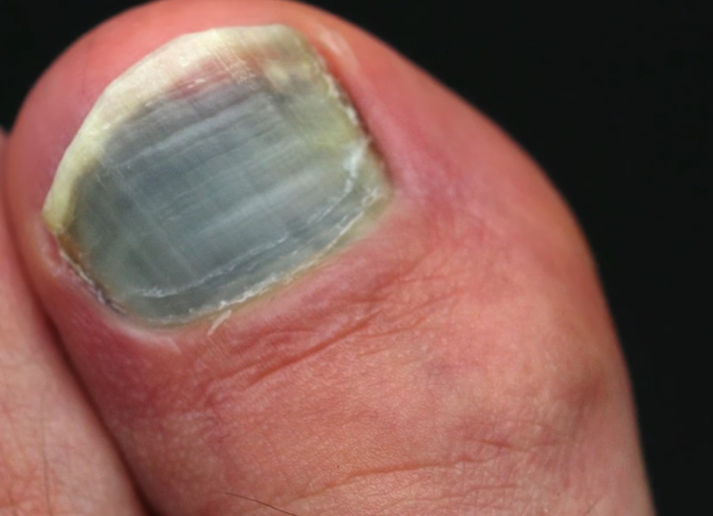 발톱이 검게 변하는 이유