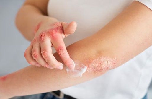 땀띠-원인-증상-없애는-방법-5