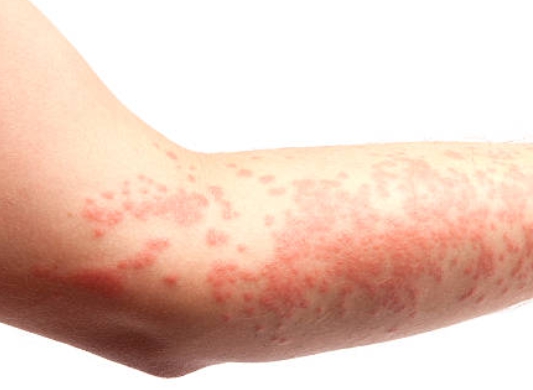 팔에 발생한 두드러기 증상
