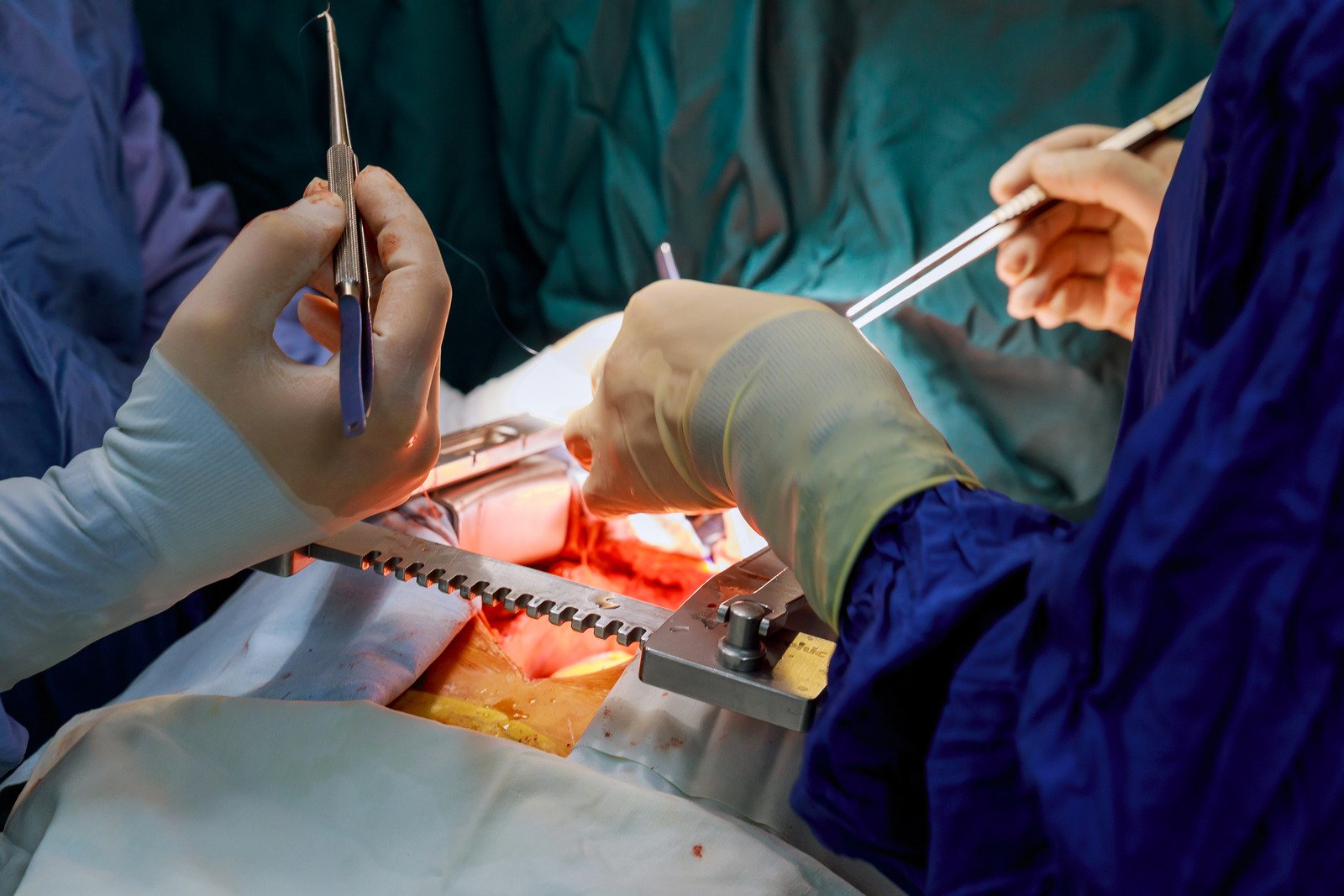 개심술(Cardiotomy): 정의, 과정 및 중요성