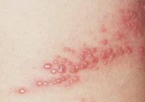 건선 초기 증상