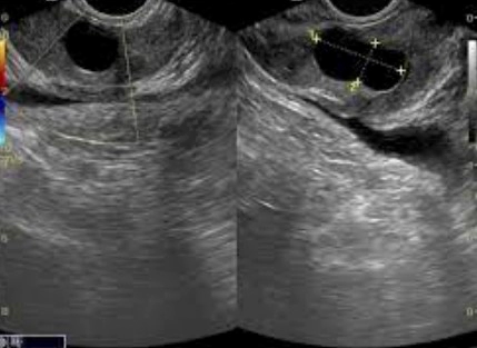 전립선 낭종 치료