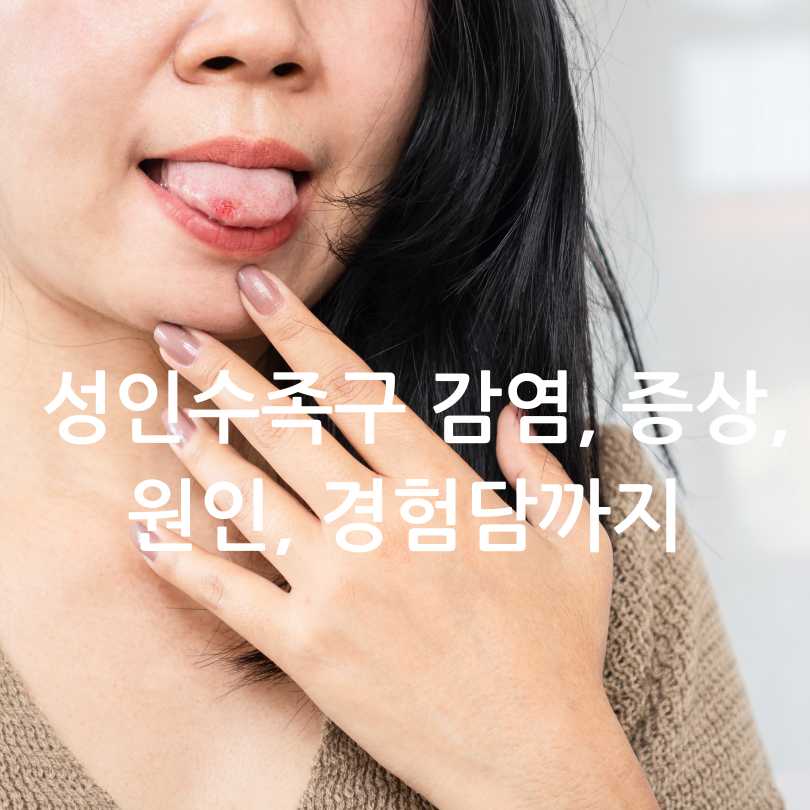 성인수족구 감염, 증상,원인, 경험담까지