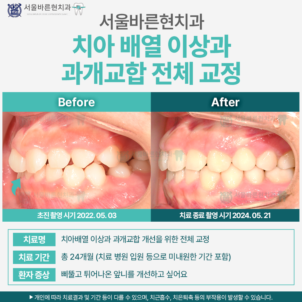 부산치아교정