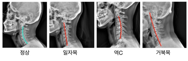 일자목, 거북목 x-ray
