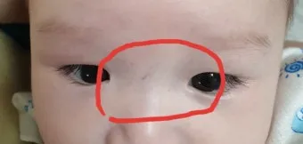눈과 눈사이 점 관상 의미와 해석_8