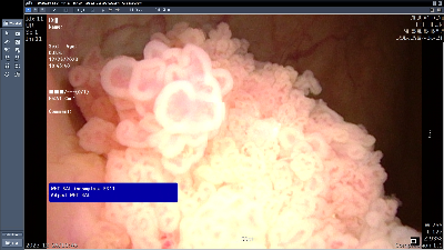 방광암 내시경 사진