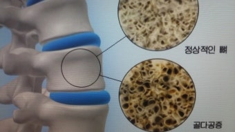 골다공증 환자를 위한 안전한 운동 처방 가이드