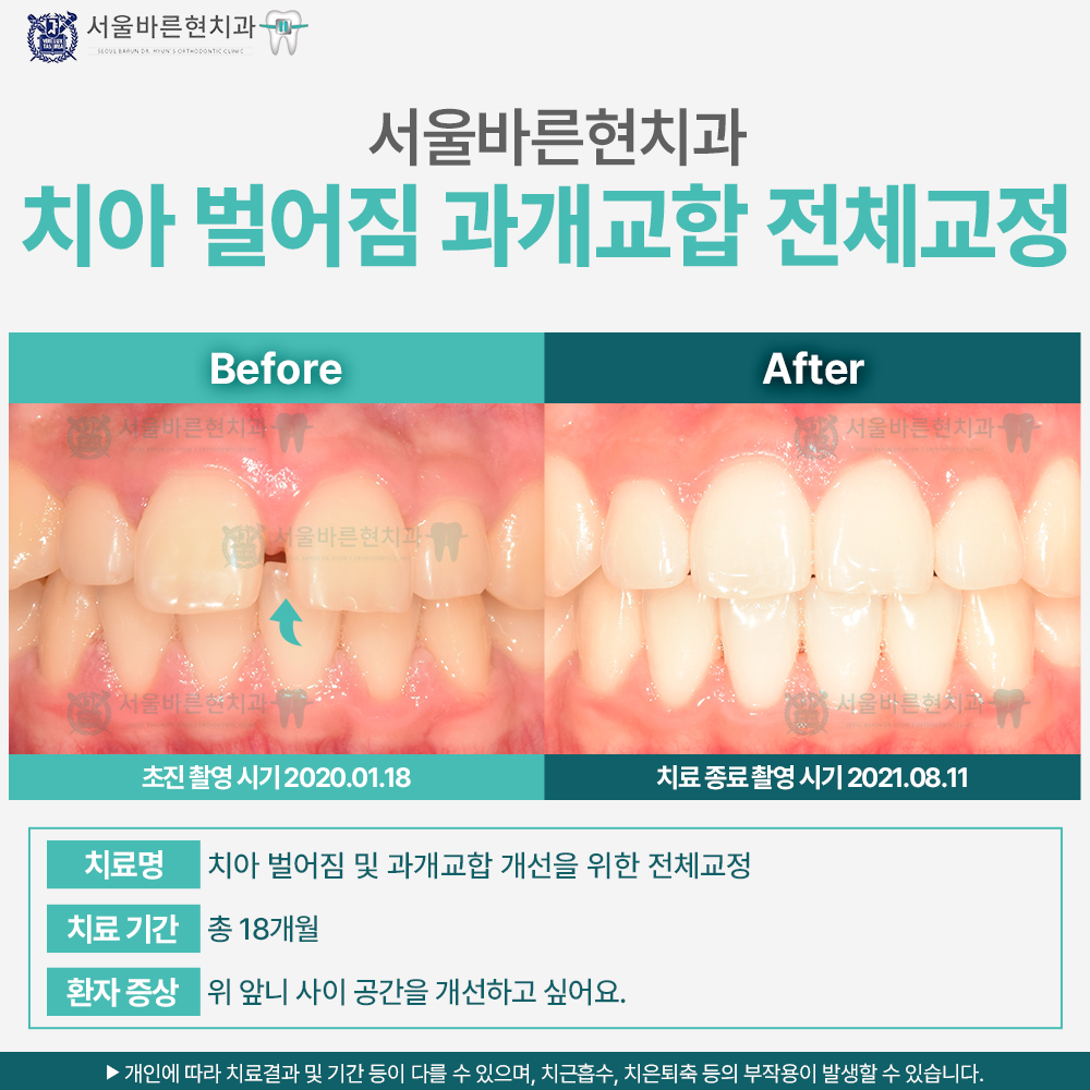 해운대과개교합교정