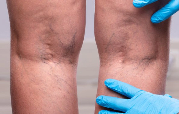 하지 정맥류 초기증상과 베나실 발거술 등의 치료방법 장단점