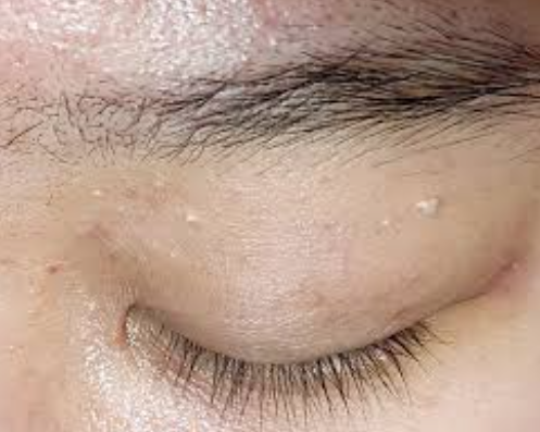 비립종 관리 및 예방