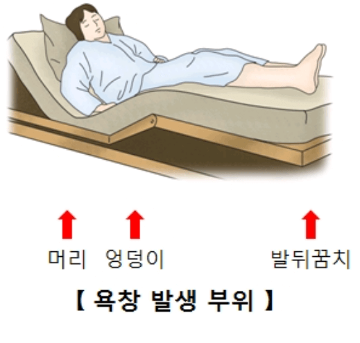욕창