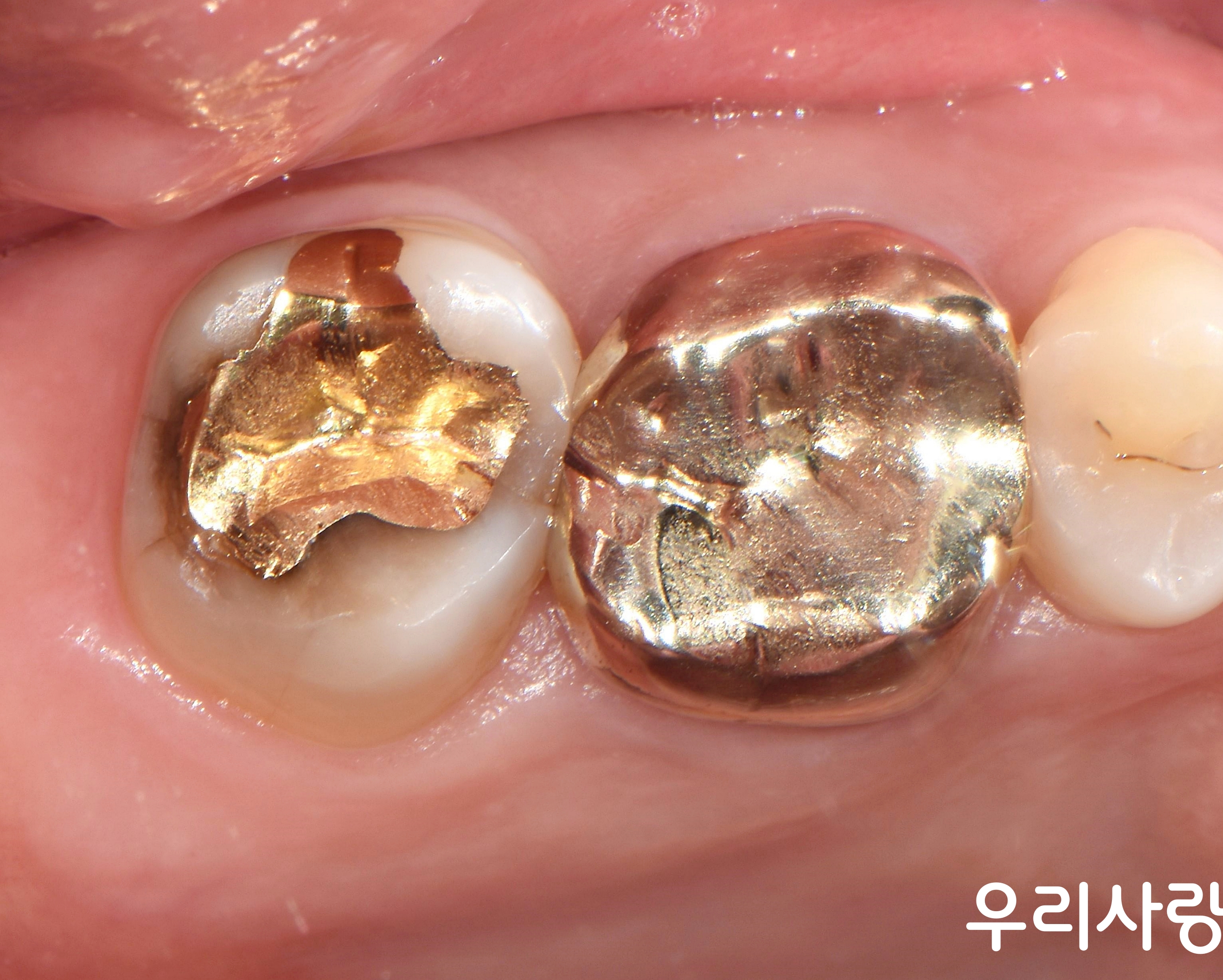 씹을 때 시큰거리는 통증을 유발하는 어금니 크랙(금 간 치아) 정밀 확대 사진