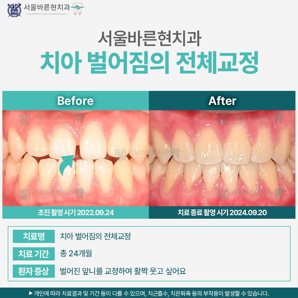 부산치아교정