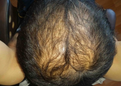 남성 탈모 대부분을 차지하는 유형 중 M자 탈모의 원인과 두타스테리드(아보다트)치료와 부작용 그리고 주의 사항 및 5년 간 실제 복용 후기