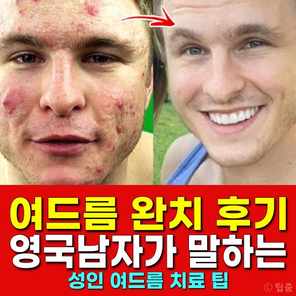 남자 성인 여드름 완치 후기,여드름 빨리 없애는법