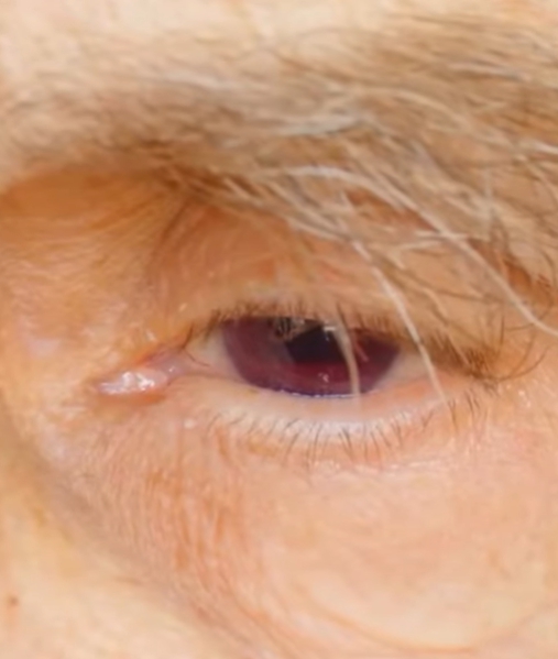 녹내장 초기증상