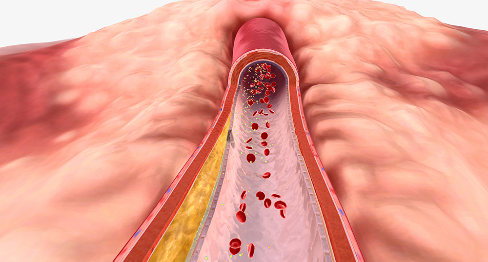 심혈관 질환이란