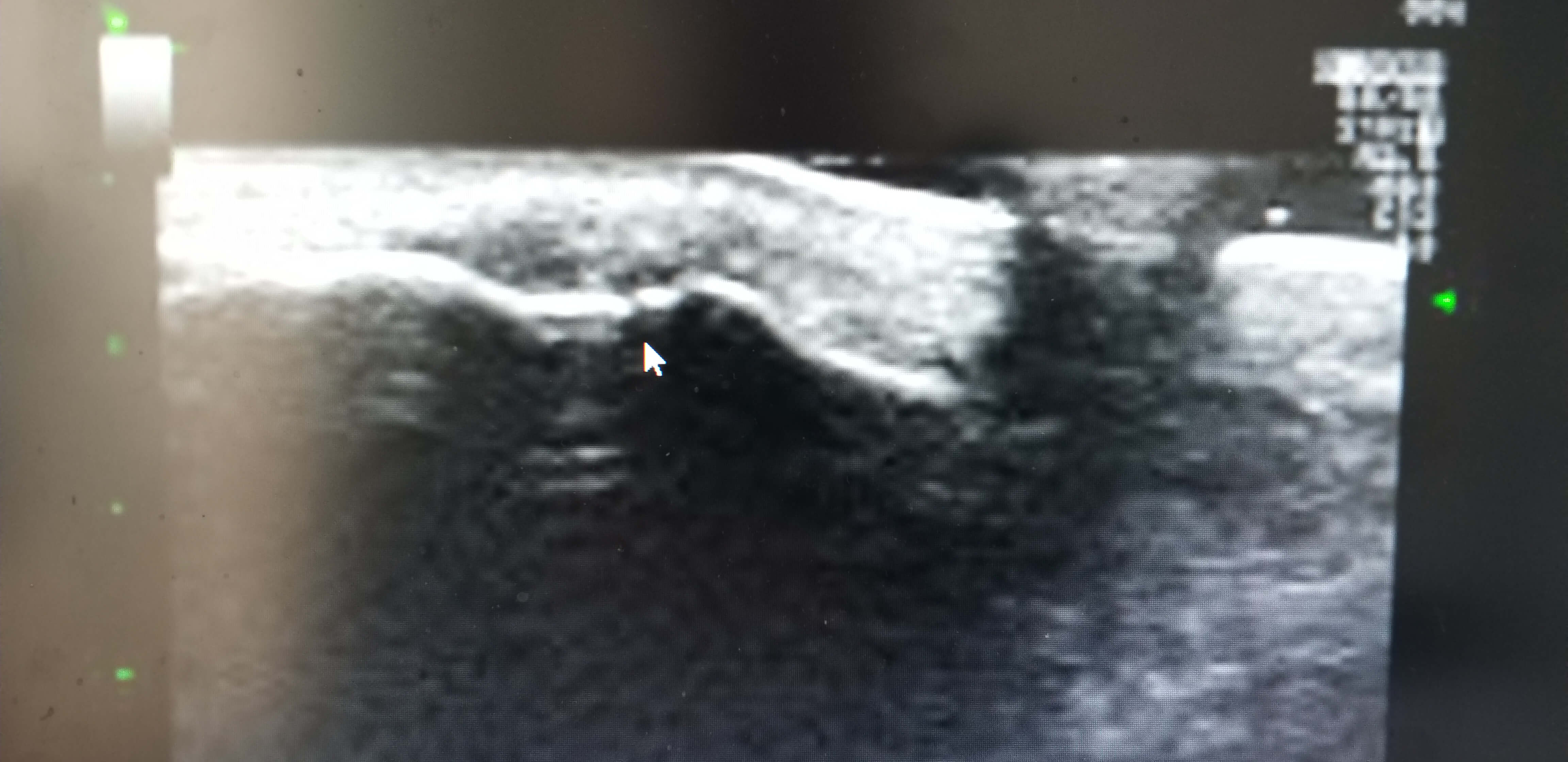 인대파열초음파사진2