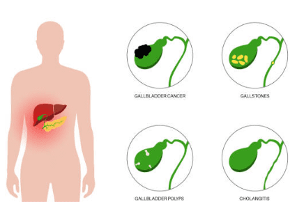 담낭염의 증상, 담낭 용종