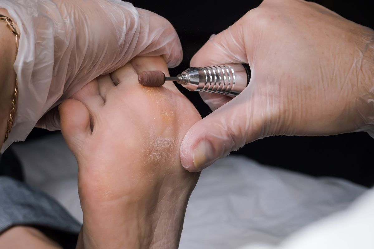 발바닥 굳은살 생기는 이유 효과적으로 없애는 법