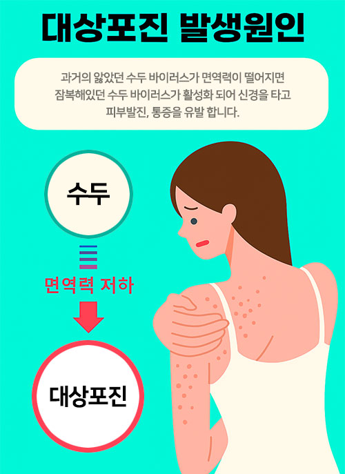 대상포진 초기증상