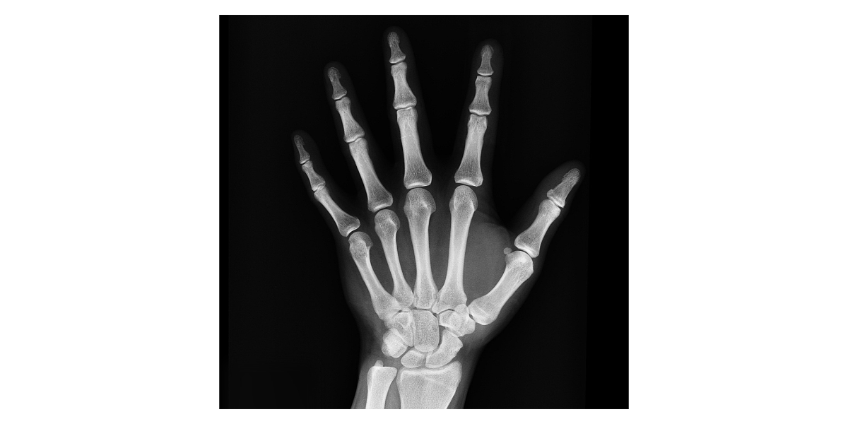 류마티스관절염 증상