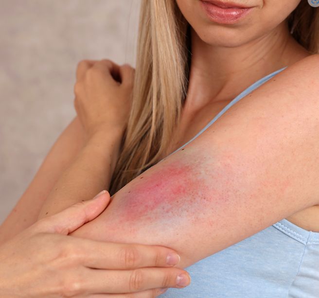 몸에 멍이 잘드는 이유