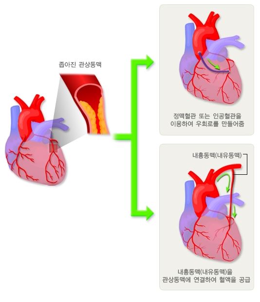 관상동맥-우회로-이식술