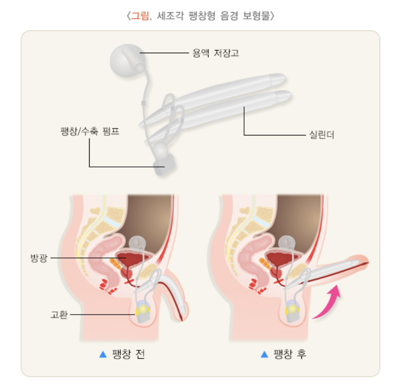 음경 보형물
