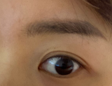 결막모반 제거 후기