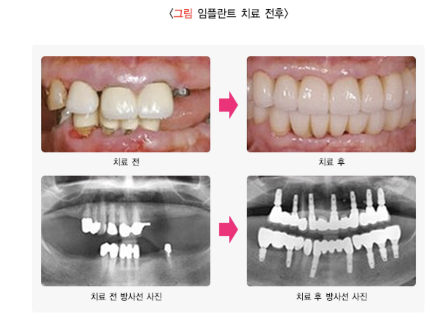 임플란트 치료 전후