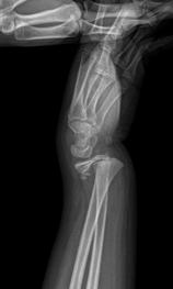 성장판 손상: 원인, 증상 및 치료 방법