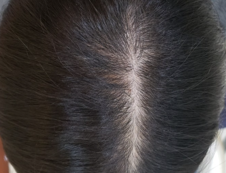 모발이식 3000모 비용 4000모 비용 부작용 과정