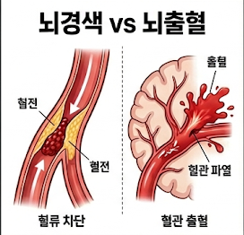 ▲ 뇌경색(허혈성)과 뇌출혈(출혈성)의 병태생리 비교