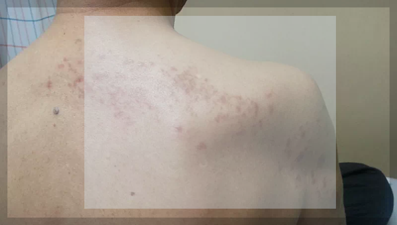 파종성 대상포진