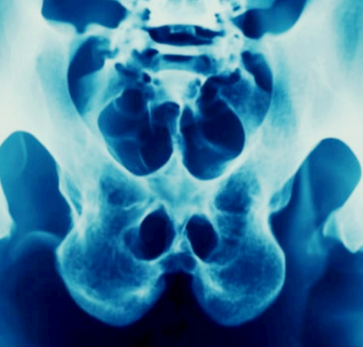 엉치뼈가 아픈이유 통증 원인