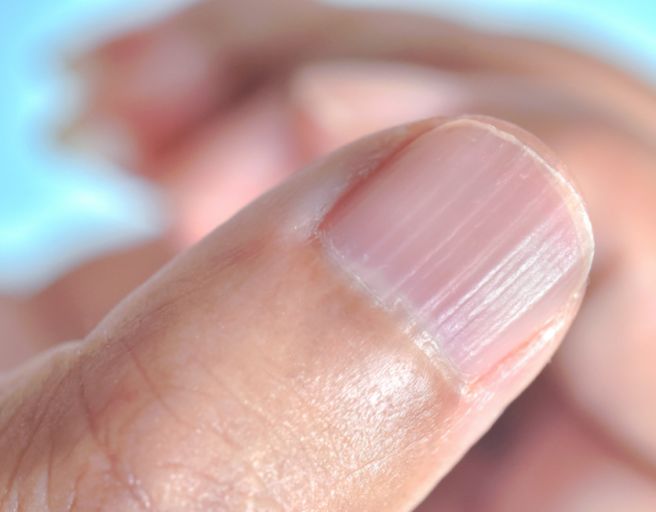 손톱 세로줄 무늬