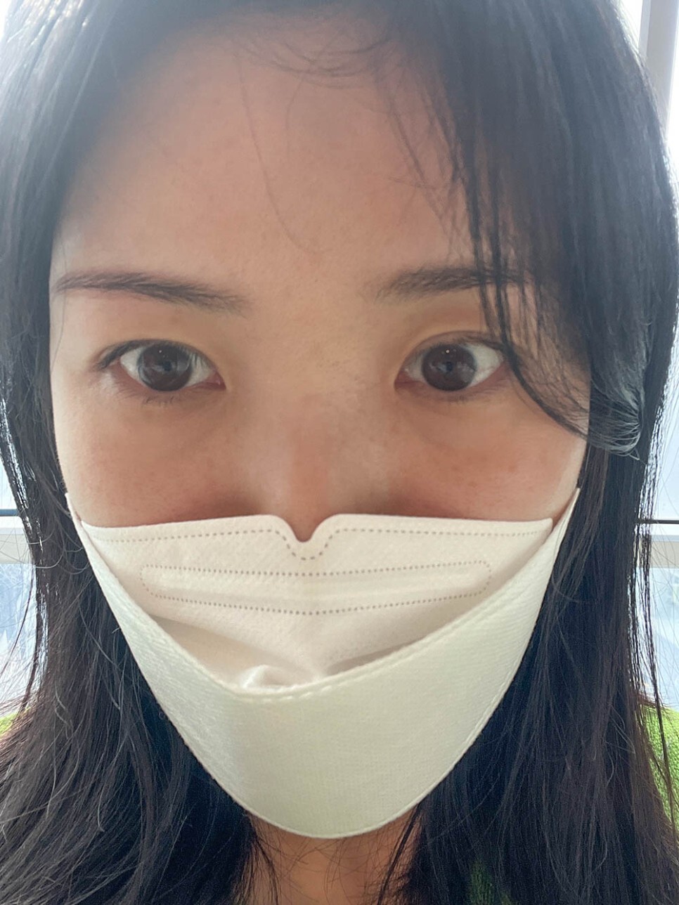 눈밑지방재배치 후기