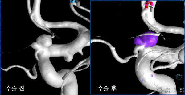 뇌동맥류 코일색전술