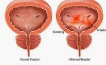 방광염-증상-건강