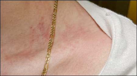 목걸이 때문에 피부가 붉게 변한 여성