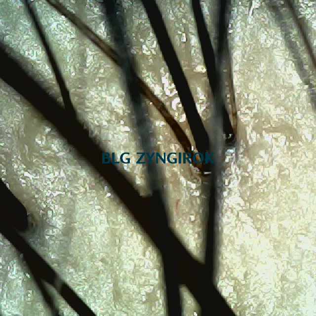 탈모 극복 프로젝트 - 정수리 두피 모습이다.